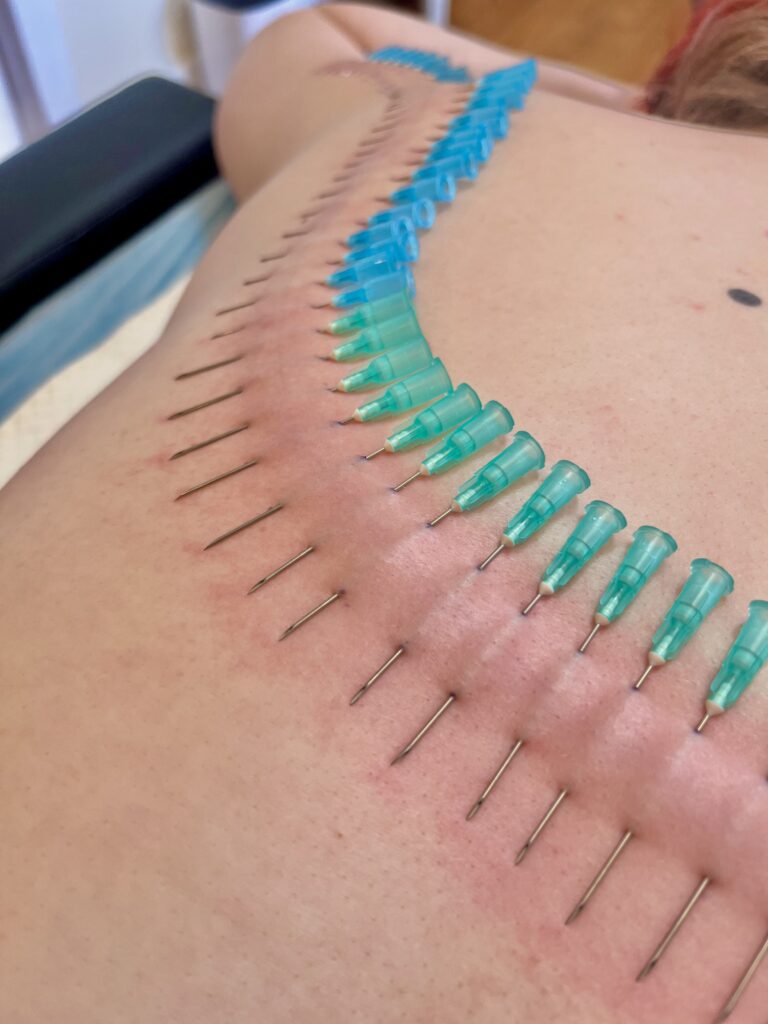 Numerous green and blue hypodermic luer lock needles that have been pierced through skin for play piercing
